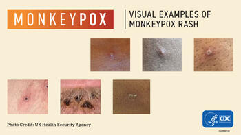 Monkeypox Rash2