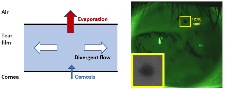 Left: Schematic of the tear film system. Right: Image of the human tear film with a breakup region highlighted. Original image courtesy of Deborah Awisi-Gyau, Tear Film and Ocular Surface Lab, Indiana University, School of Optometry